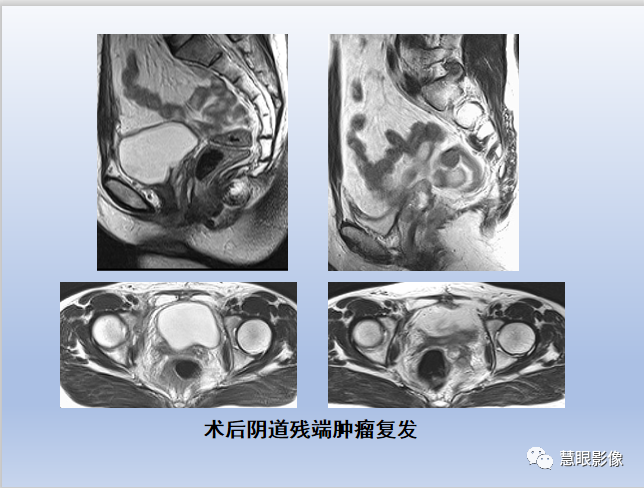 影像PPT - 【PPT】宫颈癌的MRI诊断与分期-37
