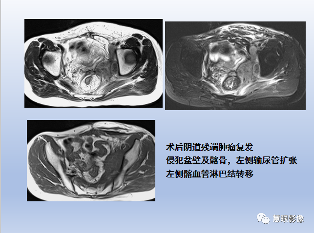 影像PPT - 【PPT】宫颈癌的MRI诊断与分期-38
