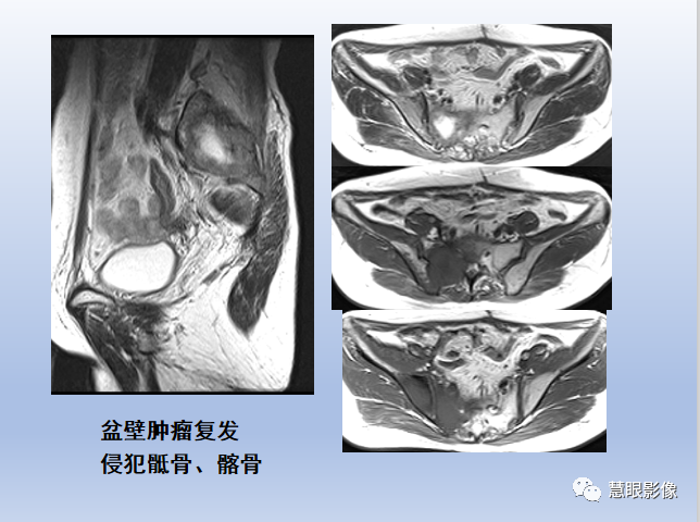 影像PPT - 【PPT】宫颈癌的MRI诊断与分期-39