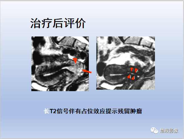 影像PPT - 【PPT】宫颈癌的MRI诊断与分期-40