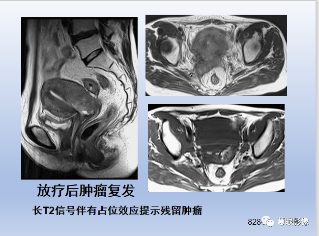影像PPT - 【PPT】宫颈癌的MRI诊断与分期-42