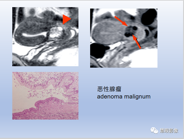 影像PPT - 【PPT】宫颈癌的MRI诊断与分期-45