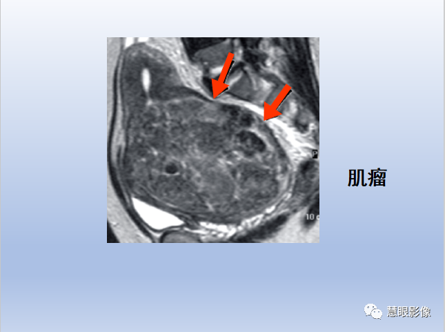 影像PPT - 【PPT】宫颈癌的MRI诊断与分期-46