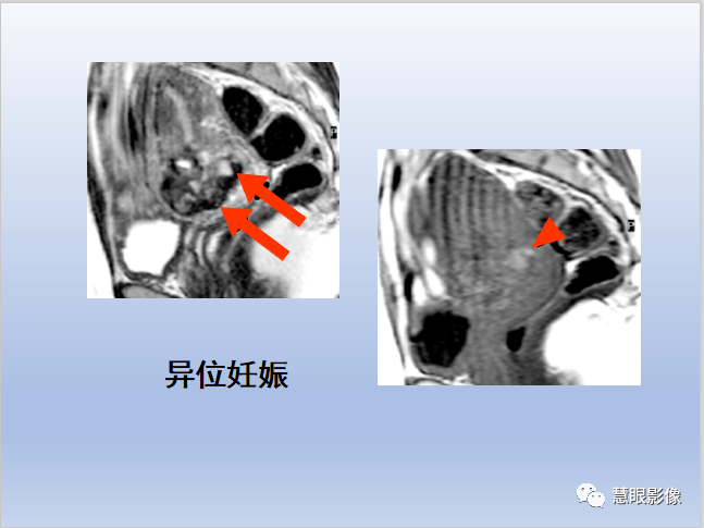 影像PPT - 【PPT】宫颈癌的MRI诊断与分期-47