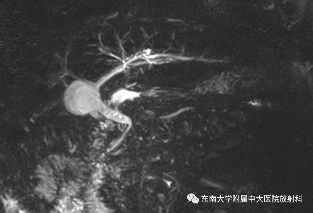 影像PPT - 【PPT】理影外合—胰腺癌鉴别诊断-9