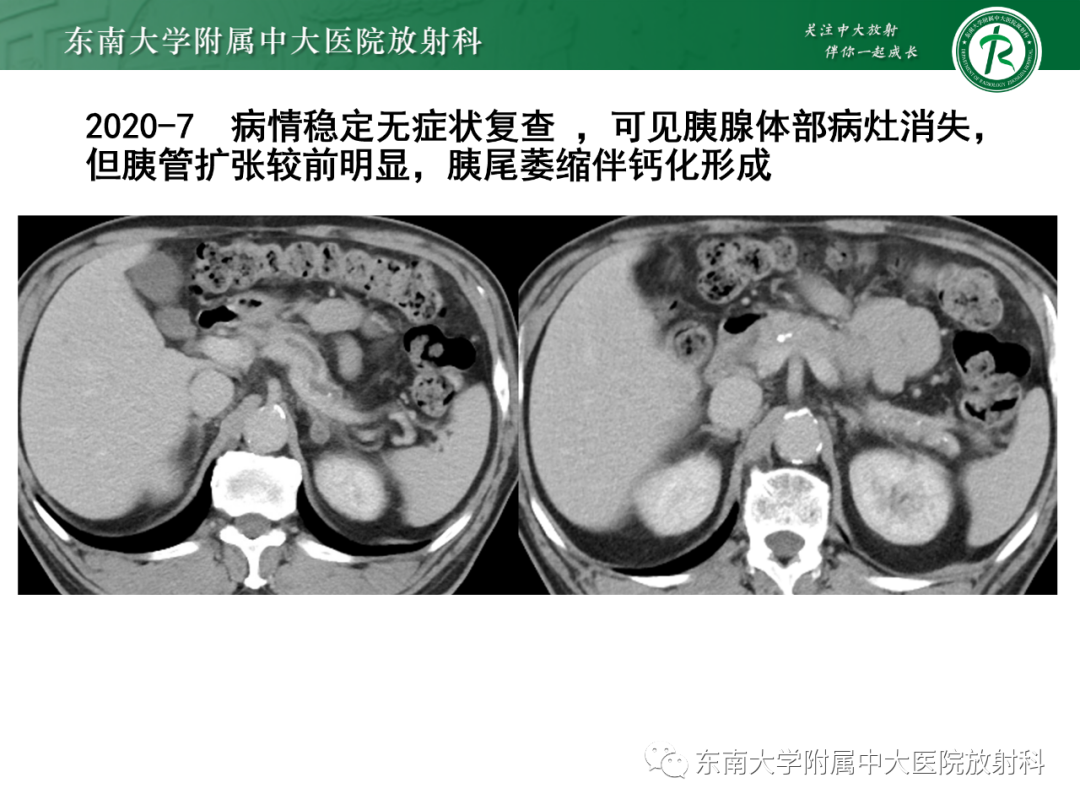 影像PPT - 【PPT】理影外合—胰腺癌鉴别诊断-18 影像PPT - 【PPT】理影外合—胰腺癌鉴别诊断-18