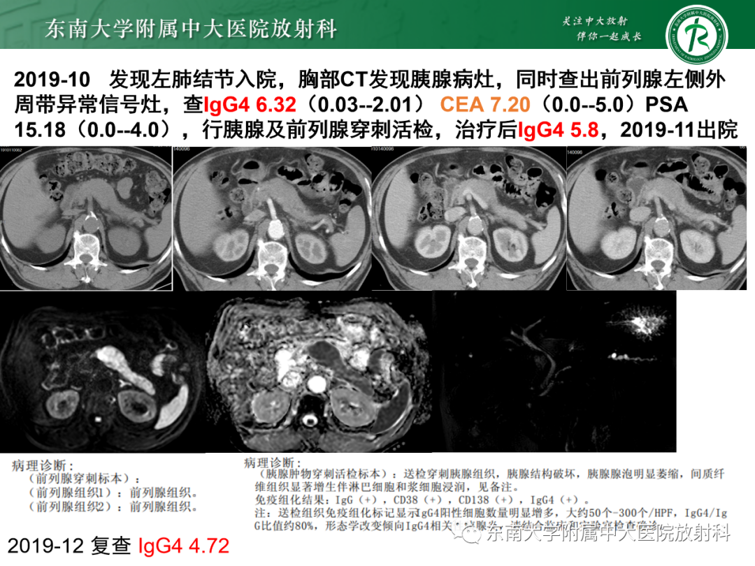 影像PPT - 【PPT】理影外合—胰腺癌鉴别诊断-17 影像PPT - 【PPT】理影外合—胰腺癌鉴别诊断-17