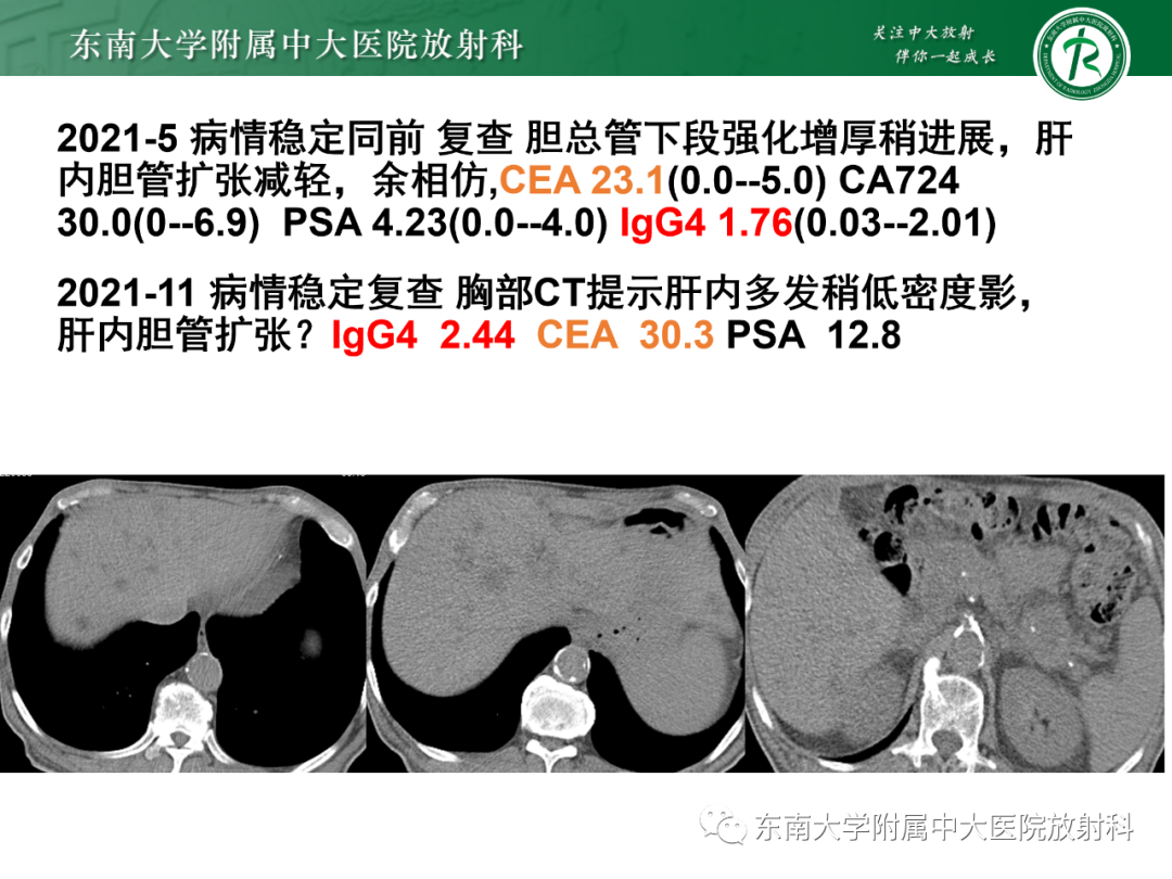 影像PPT - 【PPT】理影外合—胰腺癌鉴别诊断-20 影像PPT - 【PPT】理影外合—胰腺癌鉴别诊断-20