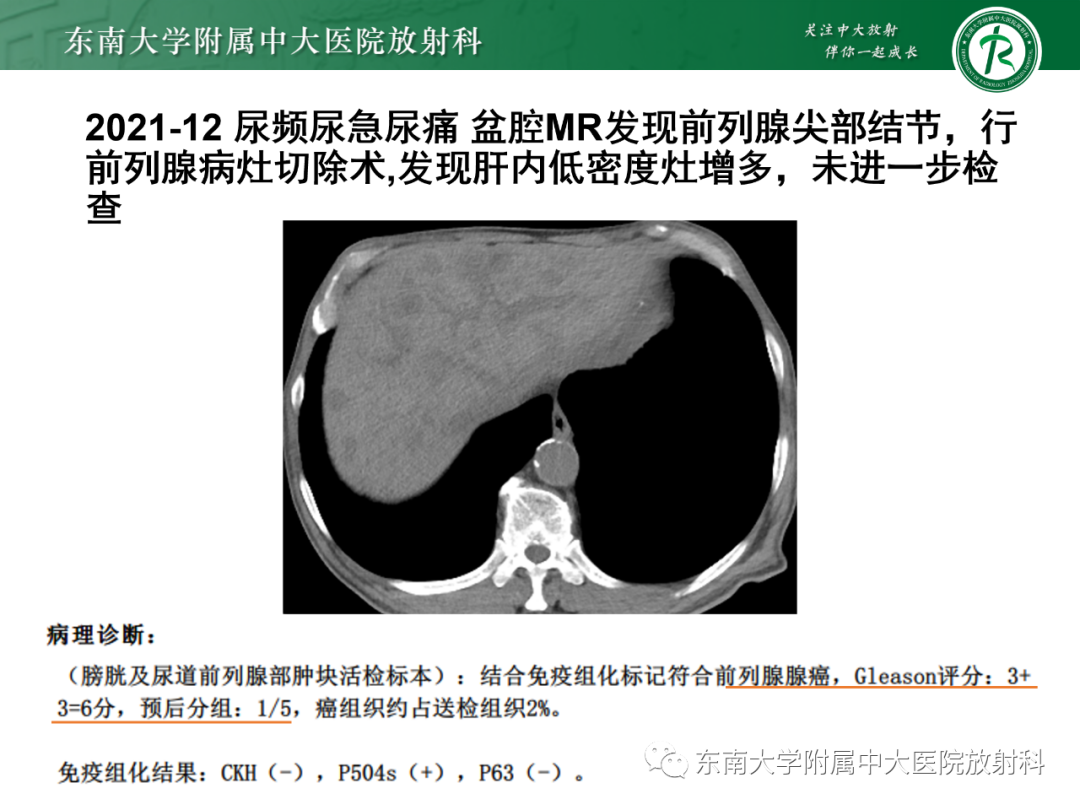 影像PPT - 【PPT】理影外合—胰腺癌鉴别诊断-21 影像PPT - 【PPT】理影外合—胰腺癌鉴别诊断-21