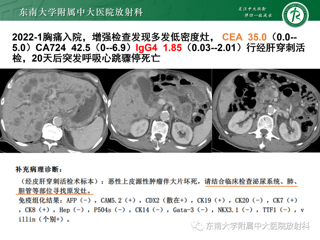 影像PPT - 【PPT】理影外合—胰腺癌鉴别诊断-22 影像PPT - 【PPT】理影外合—胰腺癌鉴别诊断-22