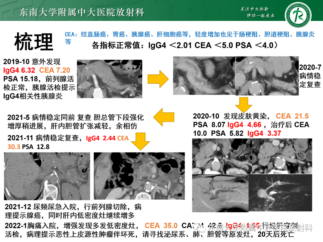 影像PPT - 【PPT】理影外合—胰腺癌鉴别诊断-23 影像PPT - 【PPT】理影外合—胰腺癌鉴别诊断-23