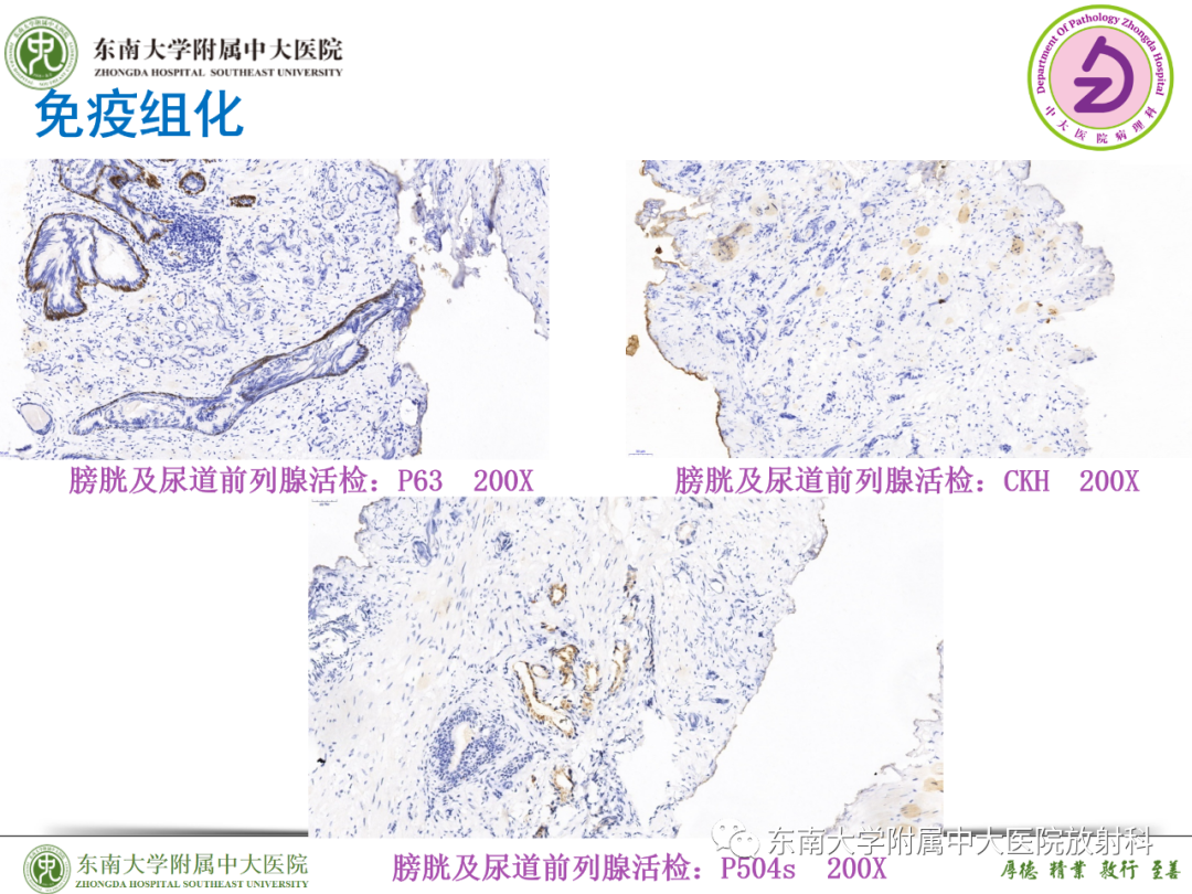 影像PPT - 【PPT】理影外合—胰腺癌鉴别诊断-37 影像PPT - 【PPT】理影外合—胰腺癌鉴别诊断-37