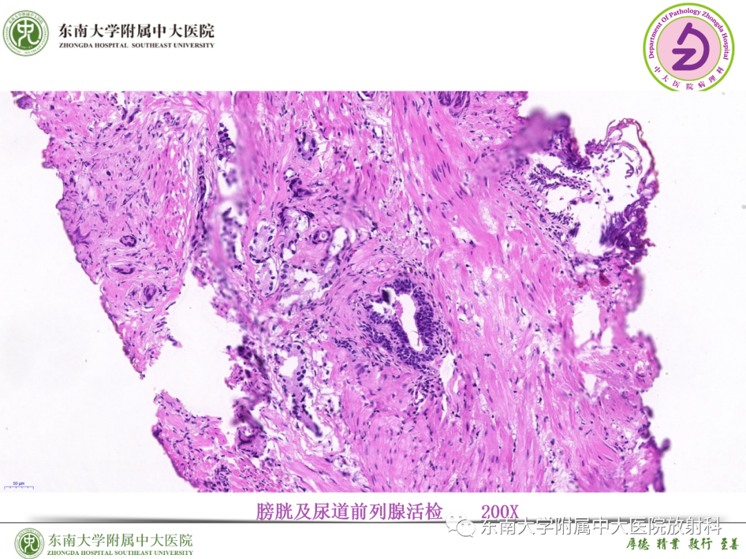 影像PPT - 【PPT】理影外合—胰腺癌鉴别诊断-36 影像PPT - 【PPT】理影外合—胰腺癌鉴别诊断-36