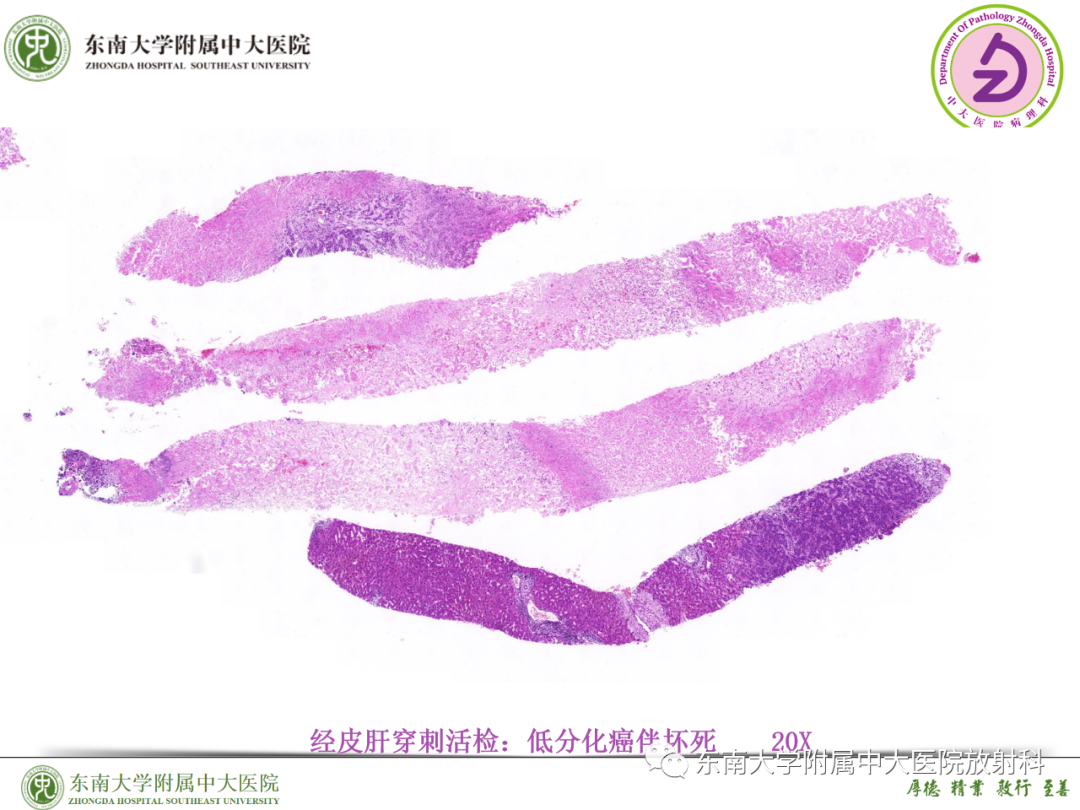 影像PPT - 【PPT】理影外合—胰腺癌鉴别诊断-38 影像PPT - 【PPT】理影外合—胰腺癌鉴别诊断-38