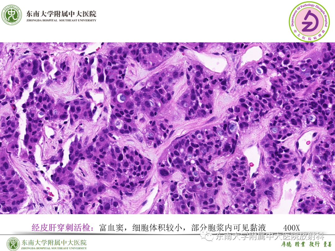 影像PPT - 【PPT】理影外合—胰腺癌鉴别诊断-41 影像PPT - 【PPT】理影外合—胰腺癌鉴别诊断-41