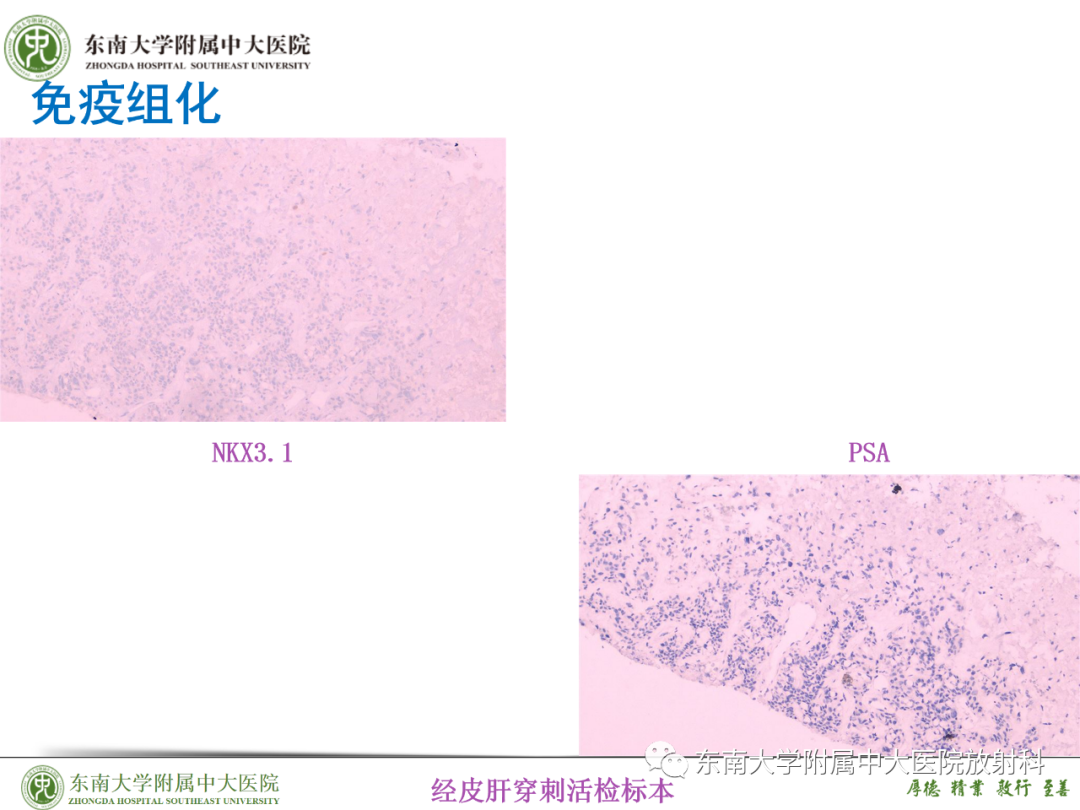 影像PPT - 【PPT】理影外合—胰腺癌鉴别诊断-48 影像PPT - 【PPT】理影外合—胰腺癌鉴别诊断-48