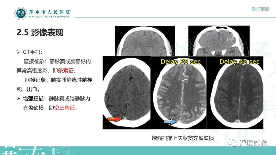 影像PPT - 【PPT】颅内静脉窦血栓形成-23