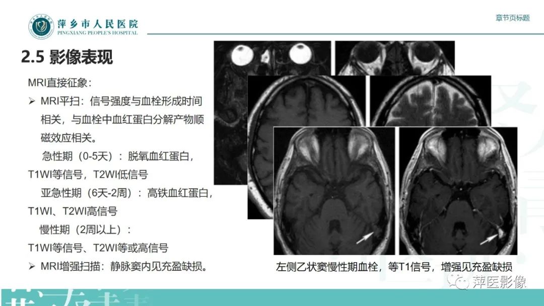 影像PPT - 【PPT】颅内静脉窦血栓形成-25