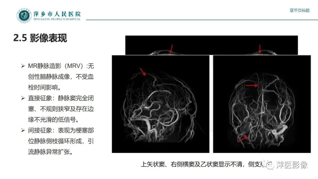 影像PPT - 【PPT】颅内静脉窦血栓形成-26