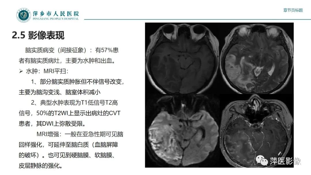影像PPT - 【PPT】颅内静脉窦血栓形成-27