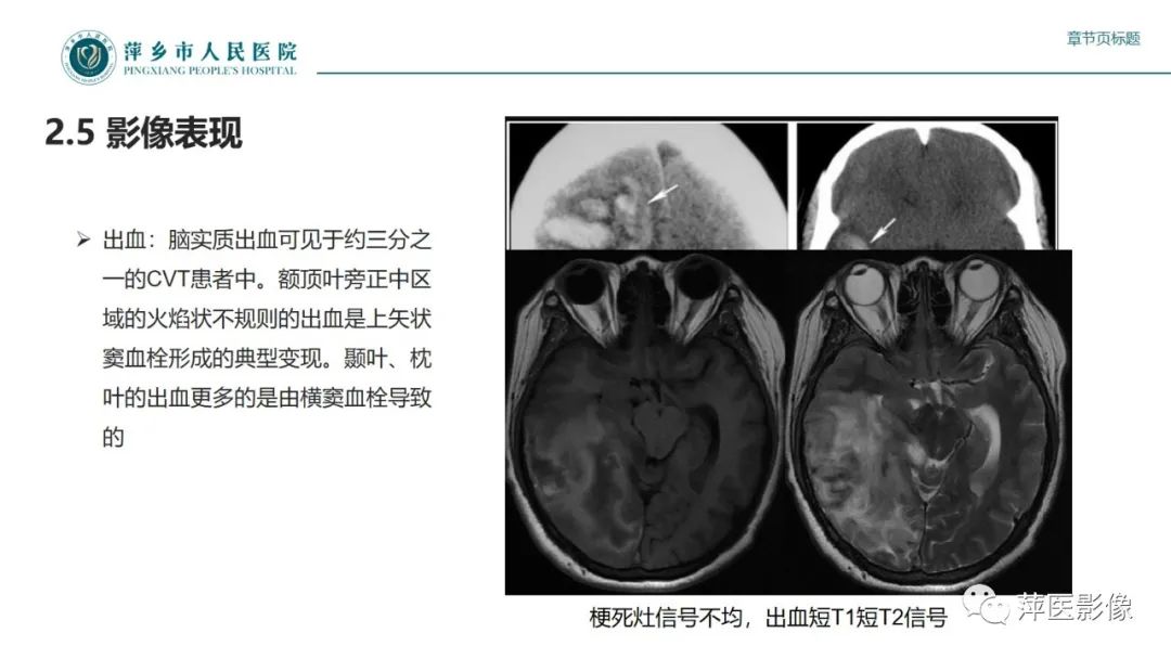 影像PPT - 【PPT】颅内静脉窦血栓形成-28