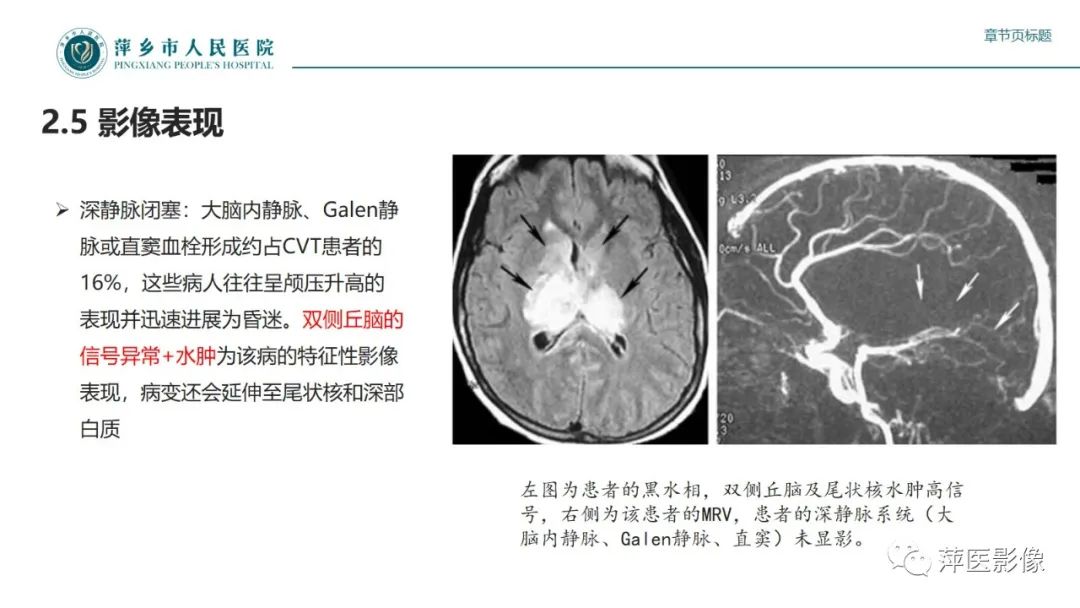 影像PPT - 【PPT】颅内静脉窦血栓形成-29