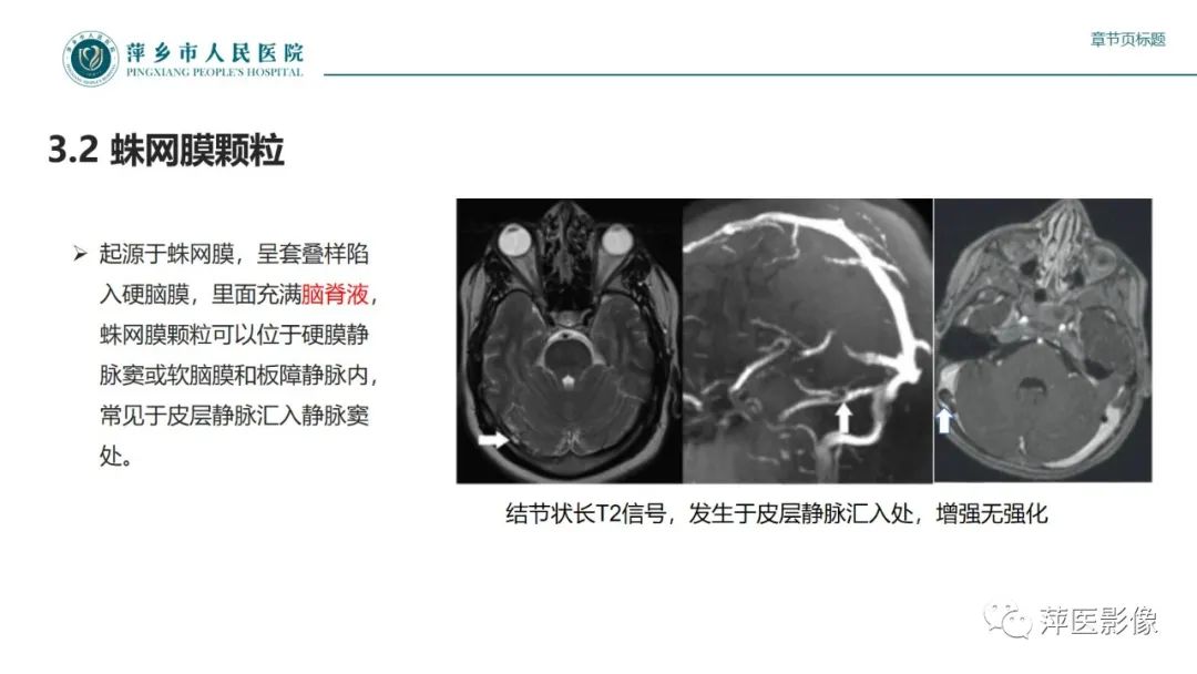 影像PPT - 【PPT】颅内静脉窦血栓形成-32