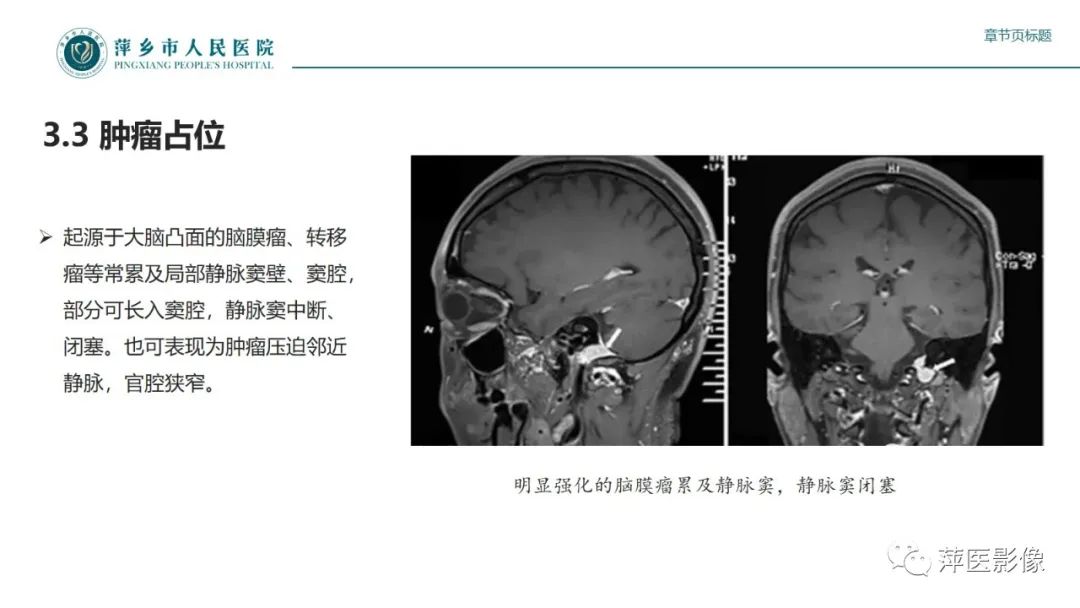 影像PPT - 【PPT】颅内静脉窦血栓形成-33