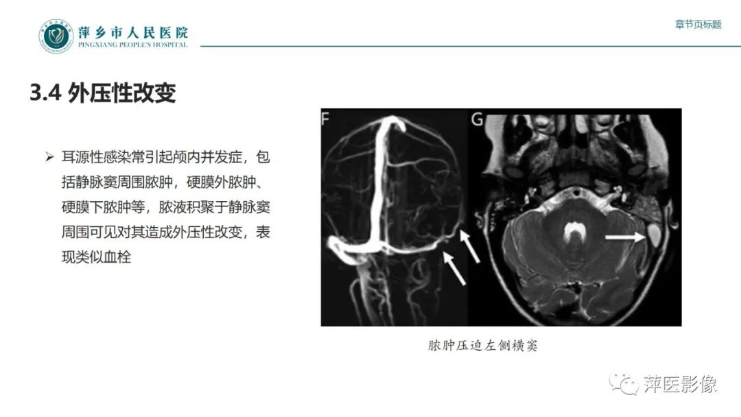 影像PPT - 【PPT】颅内静脉窦血栓形成-34