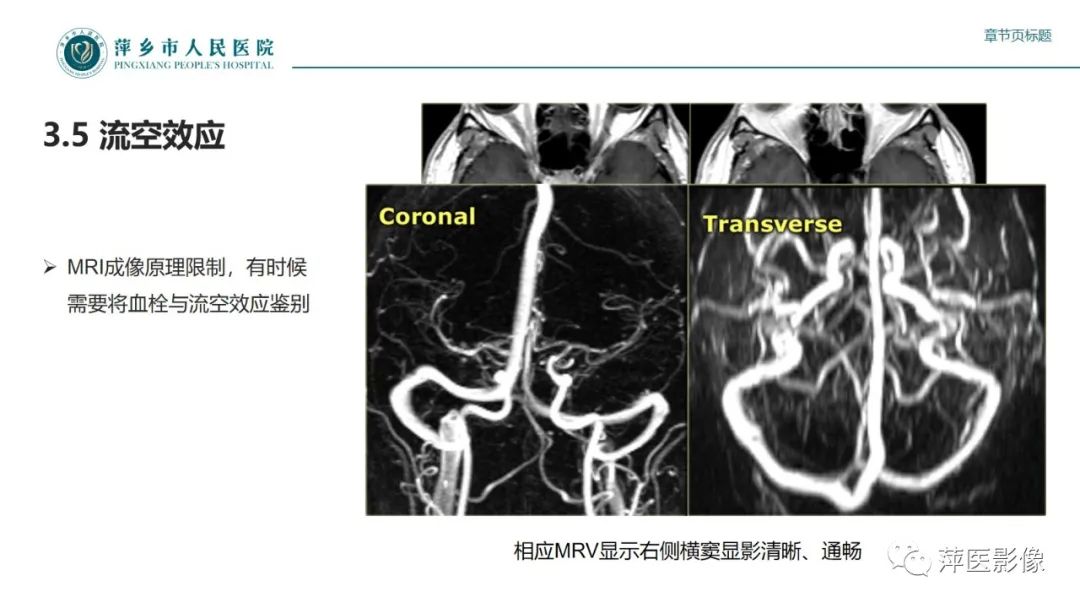 影像PPT - 【PPT】颅内静脉窦血栓形成-35