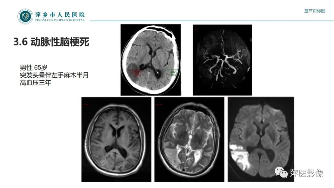影像PPT - 【PPT】颅内静脉窦血栓形成-38