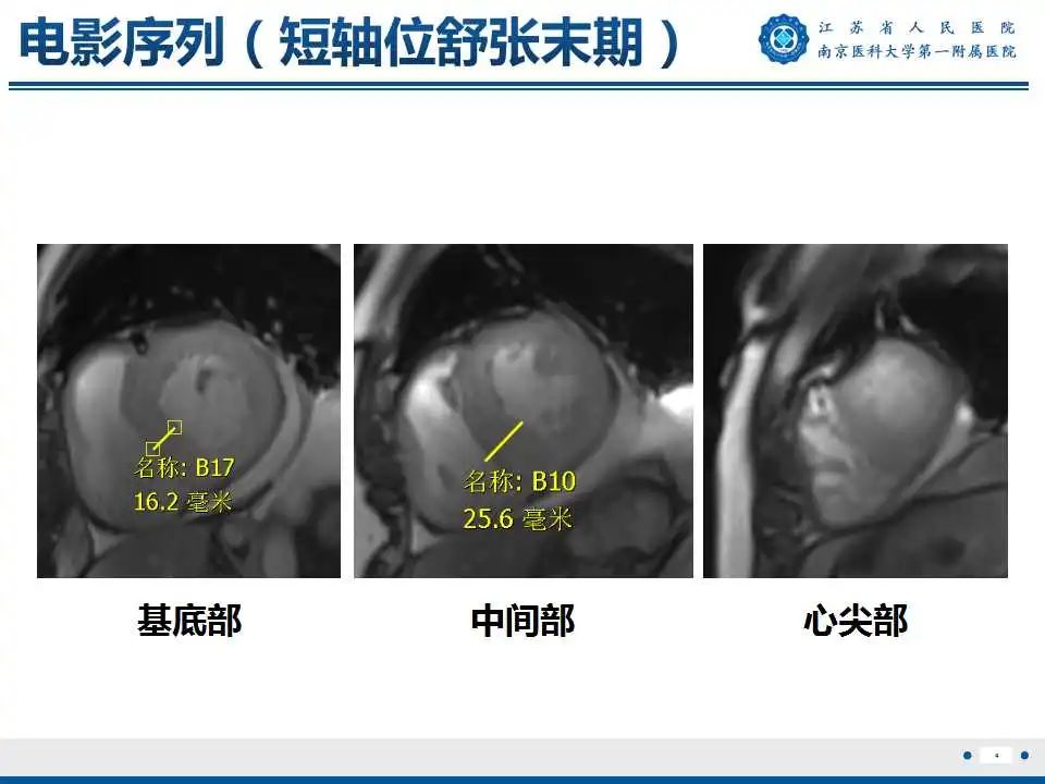 影像PPT - 【PPT】心肌淀粉样变-5