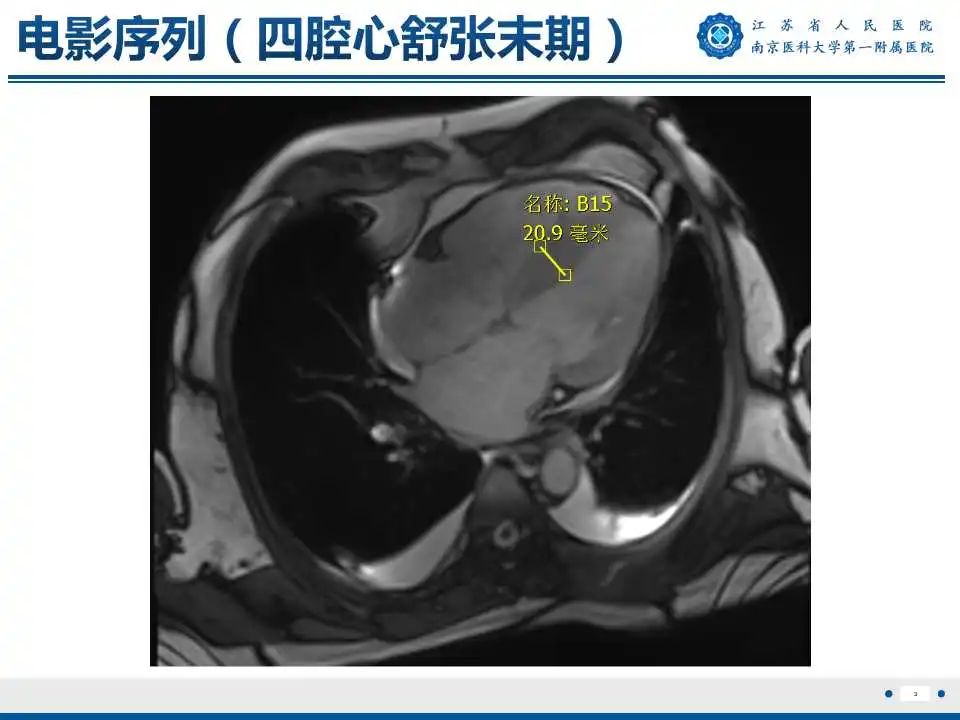 影像PPT - 【PPT】心肌淀粉样变-4