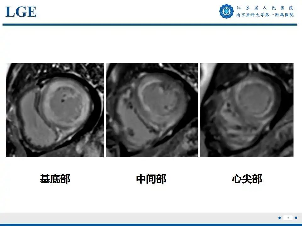 影像PPT - 【PPT】心肌淀粉样变-7