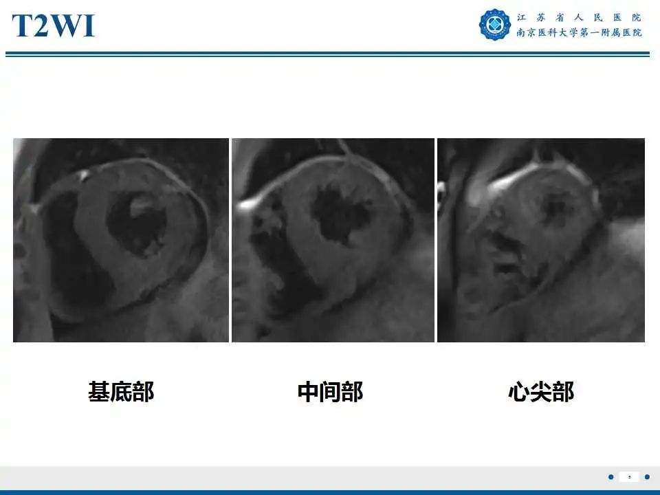 影像PPT - 【PPT】心肌淀粉样变-6
