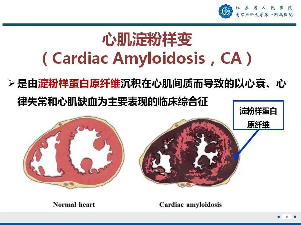 影像PPT - 【PPT】心肌淀粉样变-29