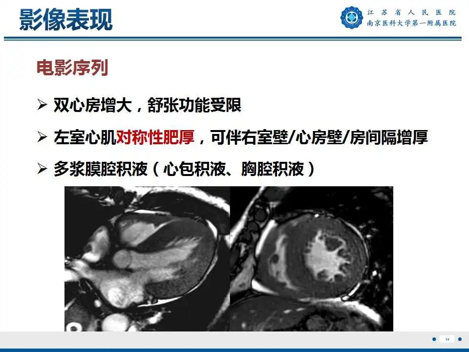 影像PPT - 【PPT】心肌淀粉样变-33