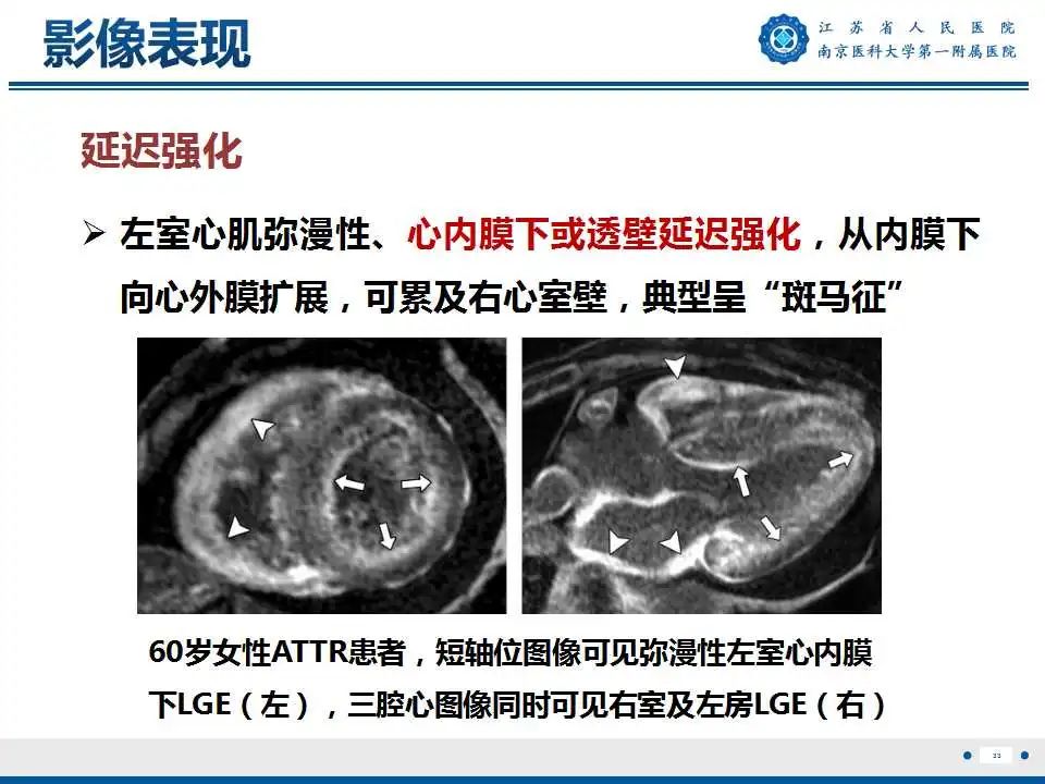 影像PPT - 【PPT】心肌淀粉样变-34