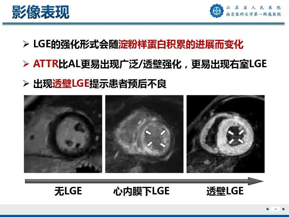 影像PPT - 【PPT】心肌淀粉样变-35