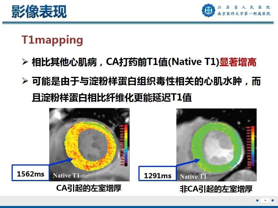 影像PPT - 【PPT】心肌淀粉样变-36