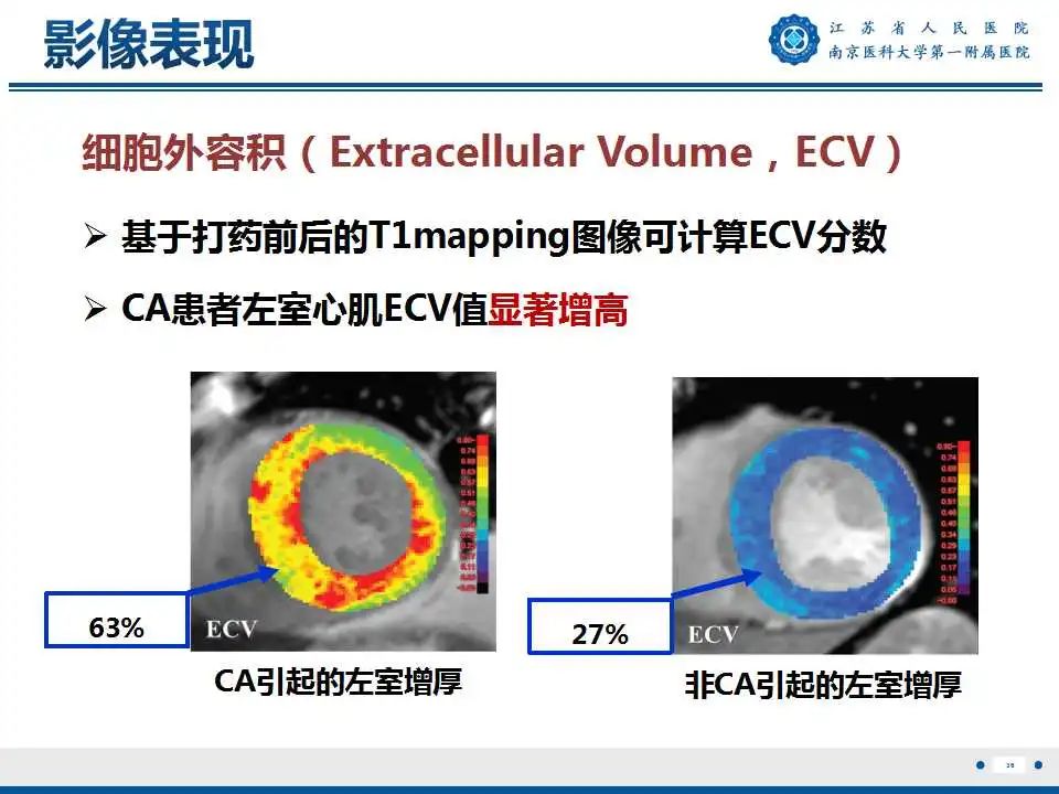 影像PPT - 【PPT】心肌淀粉样变-37