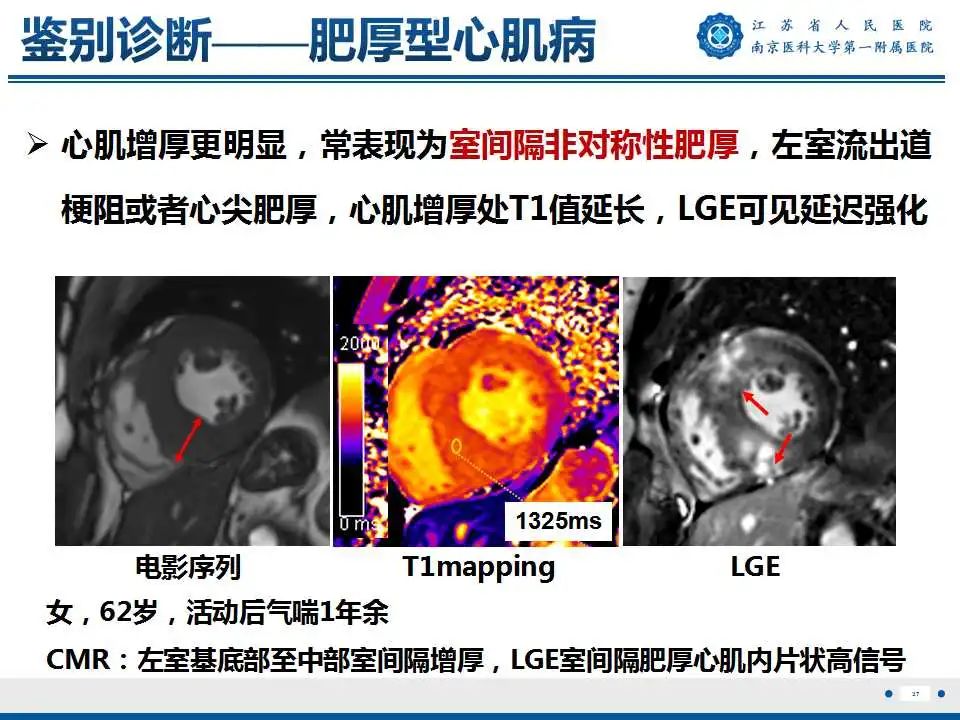 影像PPT - 【PPT】心肌淀粉样变-38