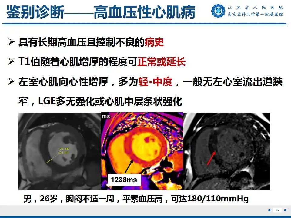 影像PPT - 【PPT】心肌淀粉样变-39