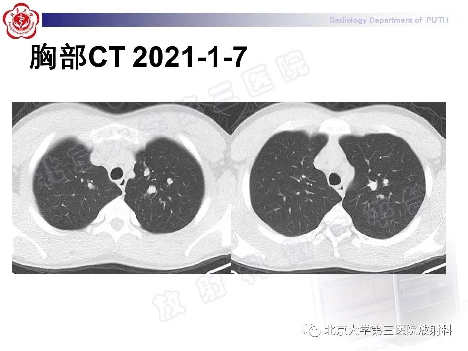 影像PPT - 【PPT】变态反应性支气管肺曲霉菌病-3