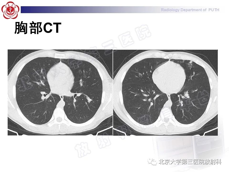 影像PPT - 【PPT】变态反应性支气管肺曲霉菌病-4