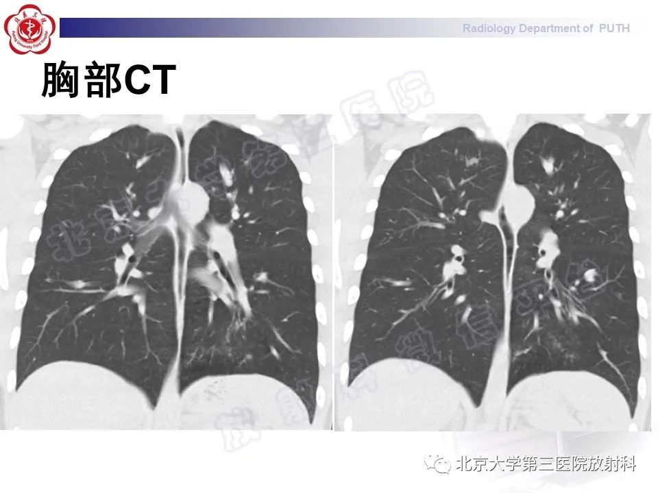 影像PPT - 【PPT】变态反应性支气管肺曲霉菌病-5