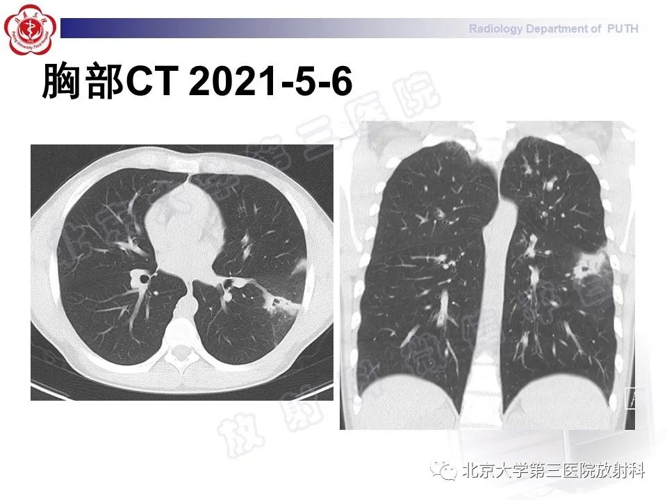 影像PPT - 【PPT】变态反应性支气管肺曲霉菌病-8