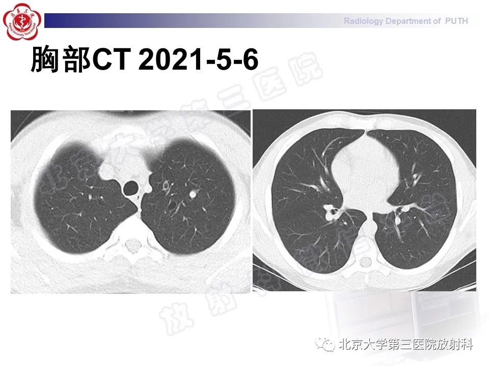 影像PPT - 【PPT】变态反应性支气管肺曲霉菌病-11