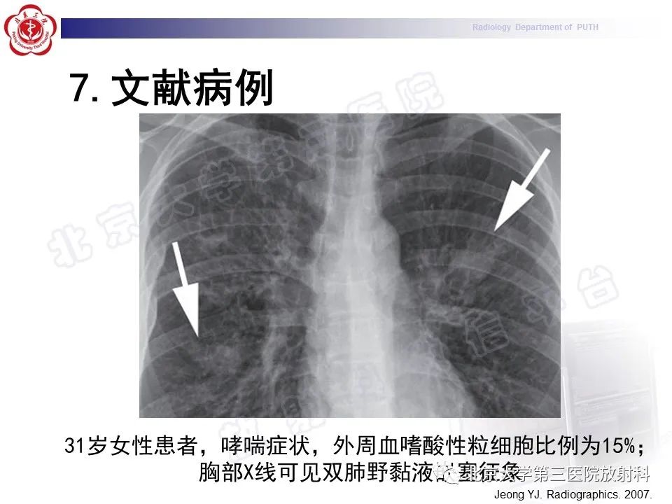 影像PPT - 【PPT】变态反应性支气管肺曲霉菌病-27