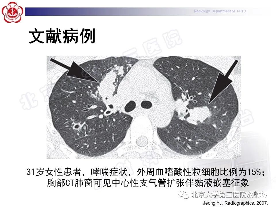影像PPT - 【PPT】变态反应性支气管肺曲霉菌病-28